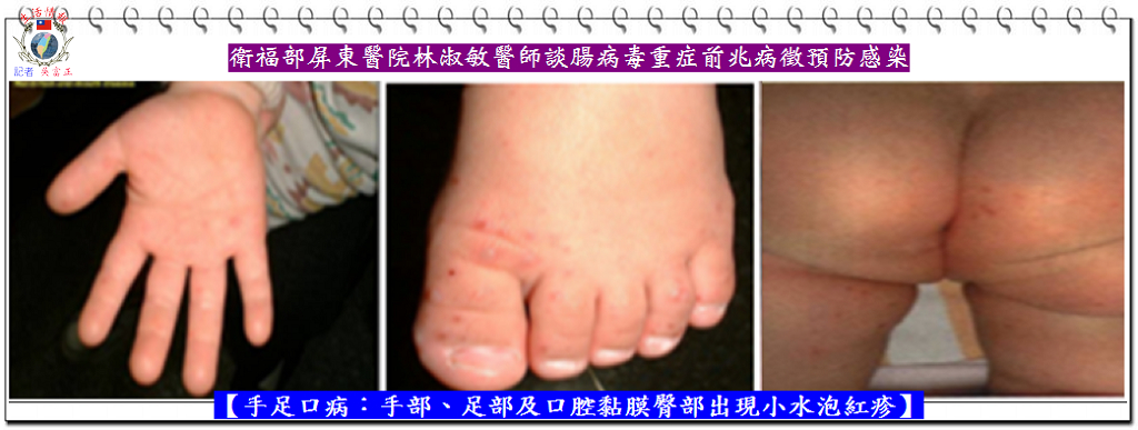衛福部屏東醫院林淑敏醫師談腸病毒重症前兆病徵預防感染